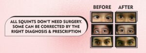 Squint Surgery vs Non-Surgical Treatment: How Do We Decide What Your Child Actually Needs?